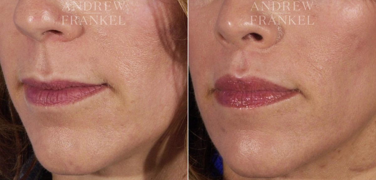Lip Lift before and after photos in Beverly Hills, CA, Patient 4575