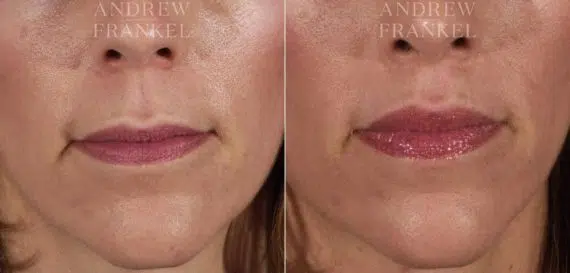 Lip Lift before and after photos in Beverly Hills, CA, Patient 4575