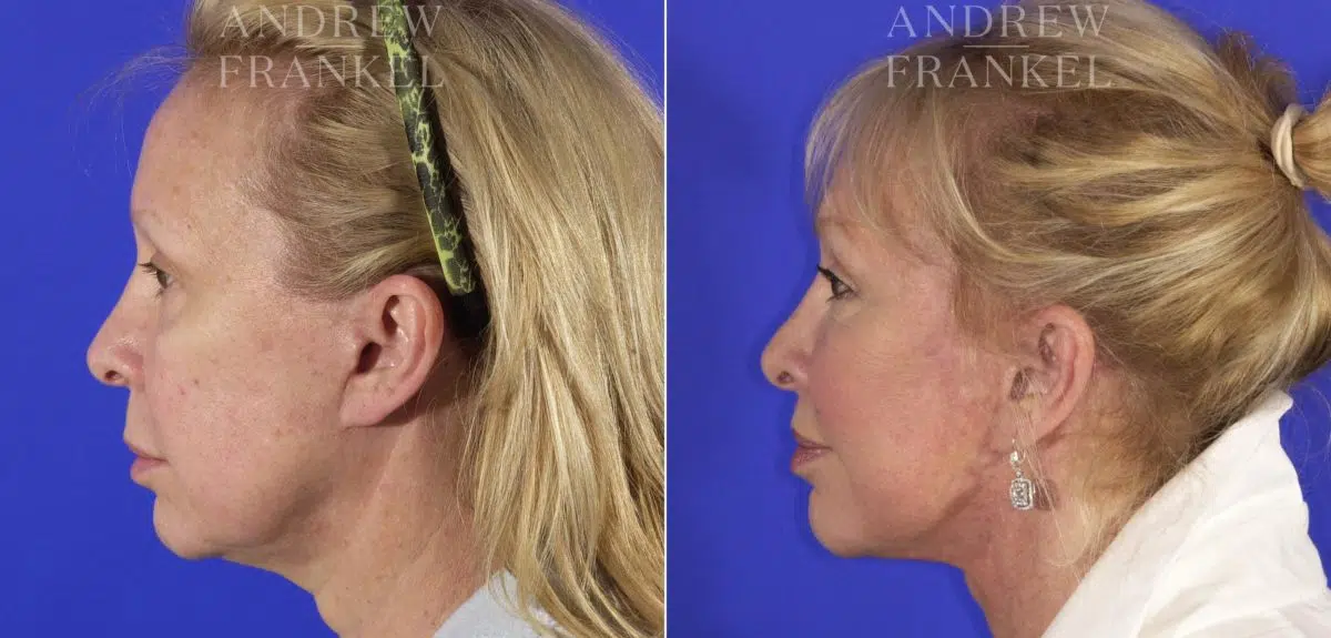 Lip Lift before and after photos in Beverly Hills, CA, Patient 4588