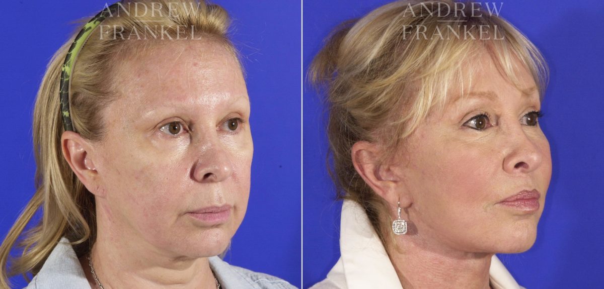 Lip Lift before and after photos in Beverly Hills, CA, Patient 4588