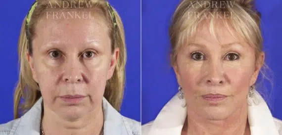 Lip Lift before and after photos in Beverly Hills, CA, Patient 4588