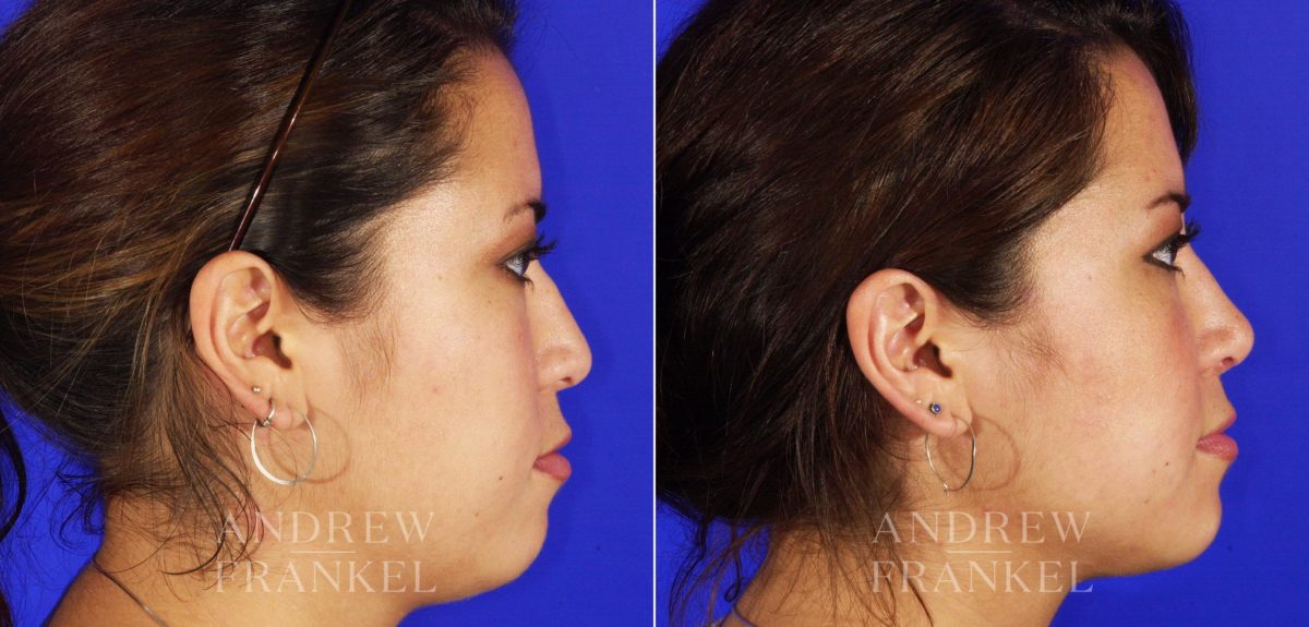 Revision Rhinoplasty before and after photos in Beverly Hills, CA, Patient 4638