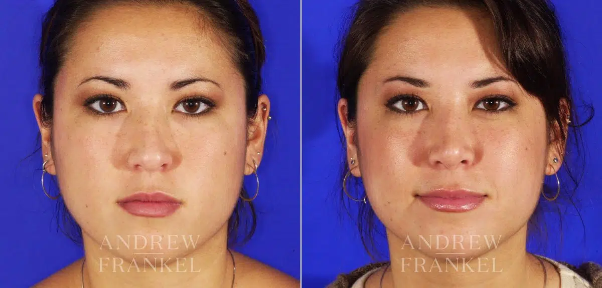 Revision Rhinoplasty before and after photos in Beverly Hills, CA, Patient 4638