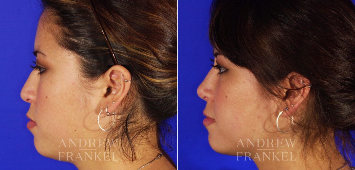 Revision Rhinoplasty before and after photos in Beverly Hills, CA, Patient 4638