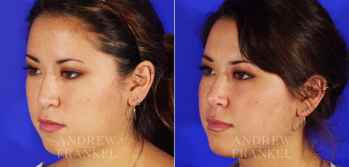 Revision Rhinoplasty before and after photos in Beverly Hills, CA, Patient 4638