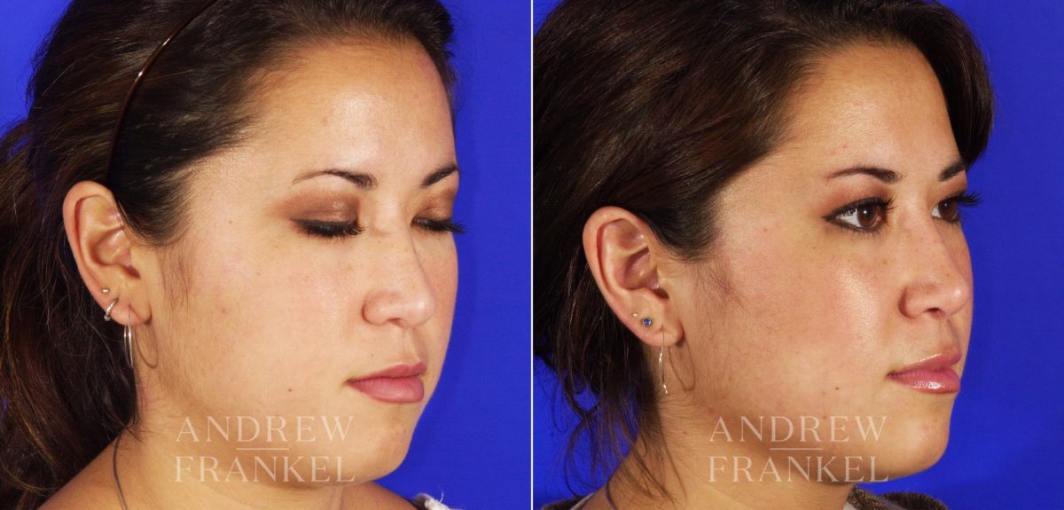 Revision Rhinoplasty before and after photos in Beverly Hills, CA, Patient 4638