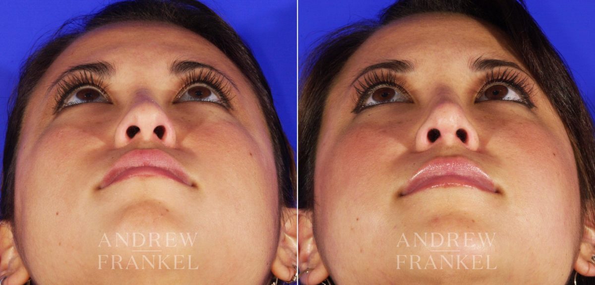 Revision Rhinoplasty before and after photos in Beverly Hills, CA, Patient 4638