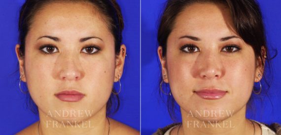 Revision Rhinoplasty before and after photos in Beverly Hills, CA, Patient 4638