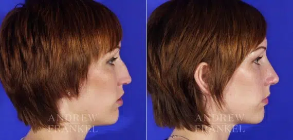 Revision Rhinoplasty before and after photos in Beverly Hills, CA, Patient 4802
