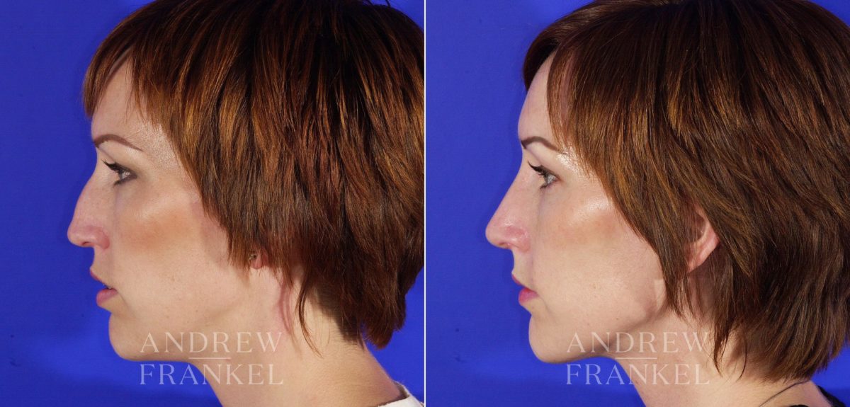 Revision Rhinoplasty before and after photos in Beverly Hills, CA, Patient 4802