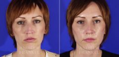 Revision Rhinoplasty before and after photos in Beverly Hills, CA, Patient 4802