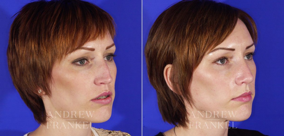Revision Rhinoplasty before and after photos in Beverly Hills, CA, Patient 4802