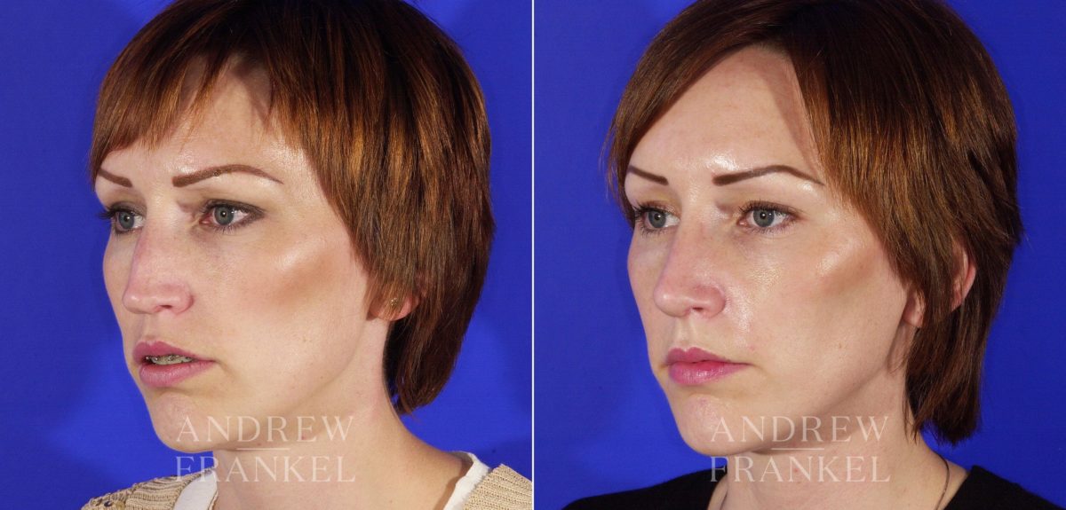 Revision Rhinoplasty before and after photos in Beverly Hills, CA, Patient 4802