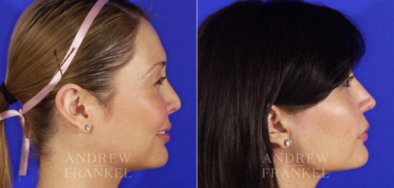 Revision Rhinoplasty before and after photos in Beverly Hills, CA, Patient 4859