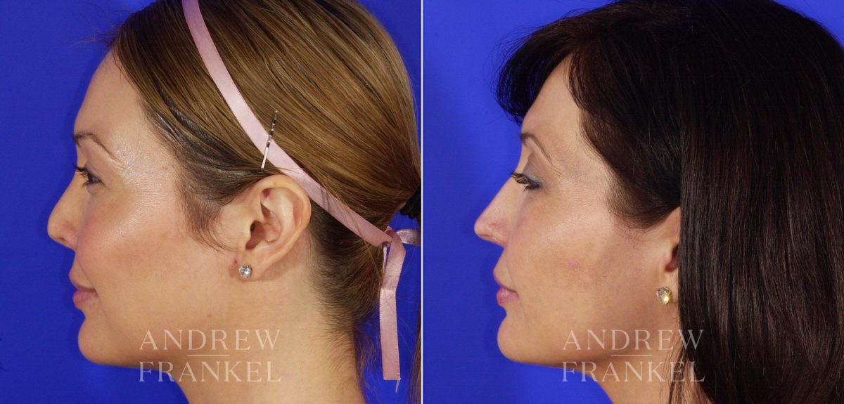 Revision Rhinoplasty before and after photos in Beverly Hills, CA, Patient 4859