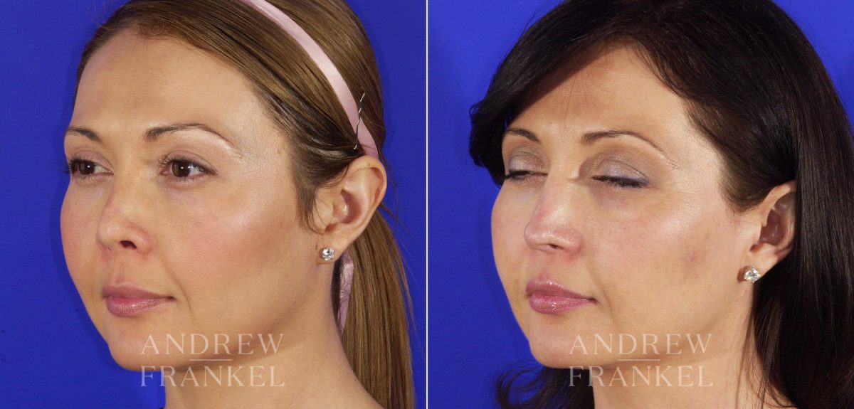 Revision Rhinoplasty before and after photos in Beverly Hills, CA, Patient 4859