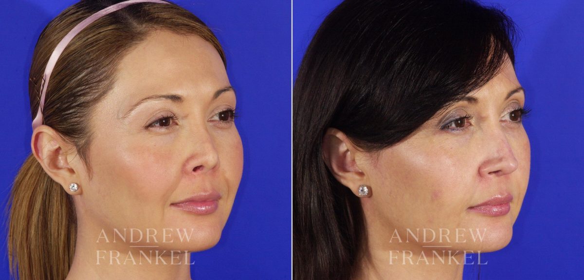 Revision Rhinoplasty before and after photos in Beverly Hills, CA, Patient 4859