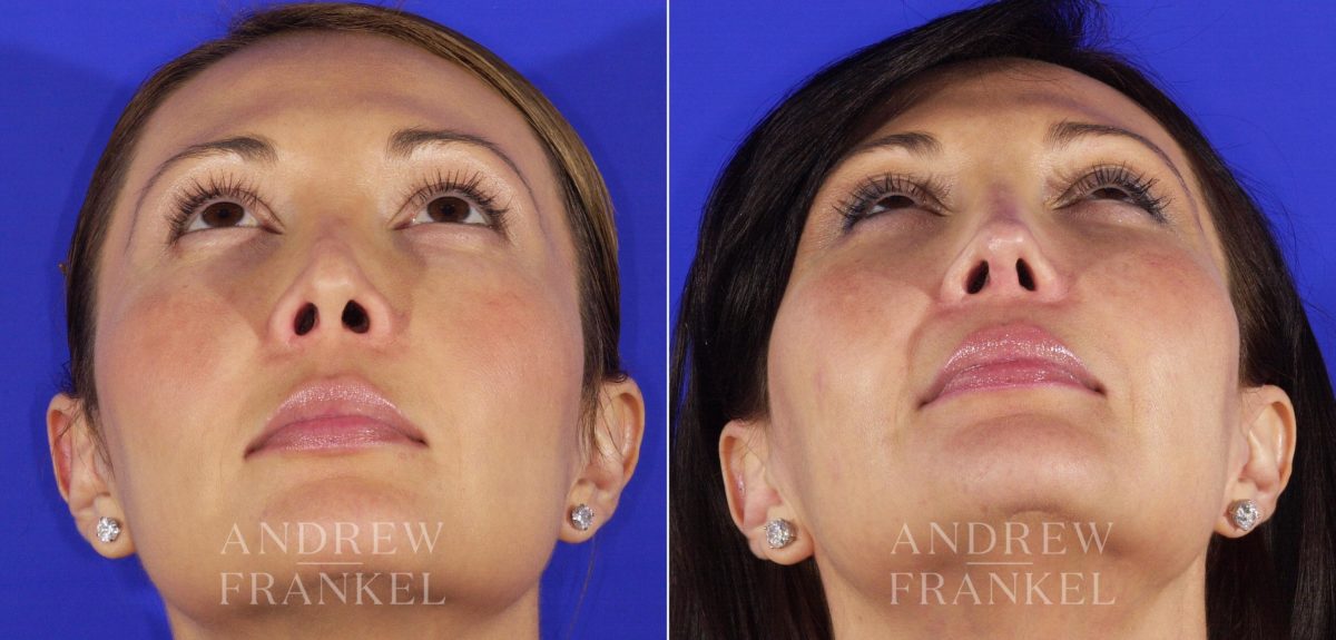 Revision Rhinoplasty before and after photos in Beverly Hills, CA, Patient 4859