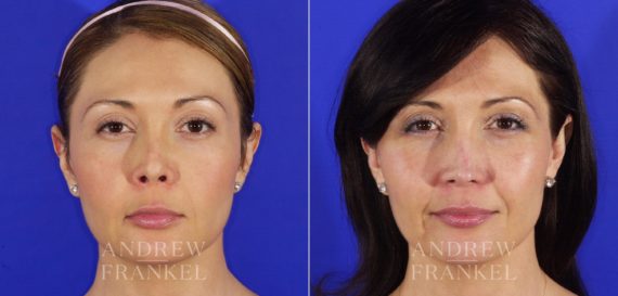Revision Rhinoplasty before and after photos in Beverly Hills, CA, Patient 4859