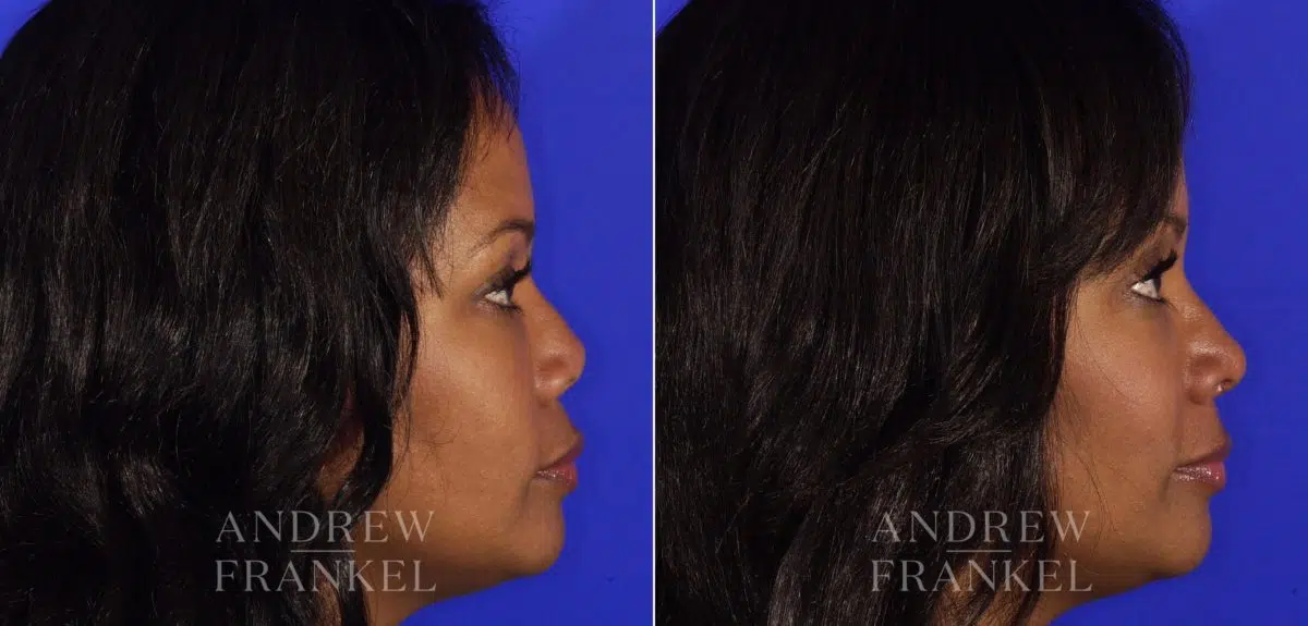 Revision Rhinoplasty before and after photos in Beverly Hills, CA, Patient 4873