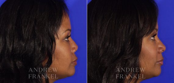 Revision Rhinoplasty before and after photos in Beverly Hills, CA, Patient 4873