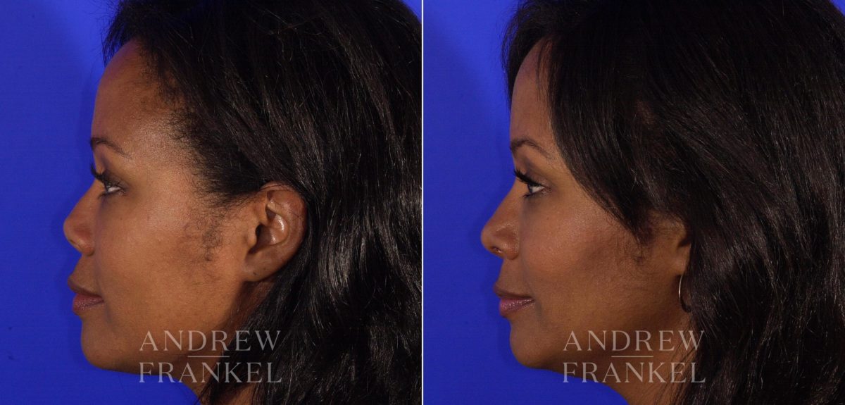 Revision Rhinoplasty before and after photos in Beverly Hills, CA, Patient 4873
