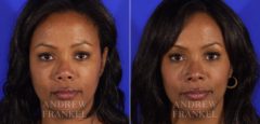 Revision Rhinoplasty before and after photos in Beverly Hills, CA, Patient 4873