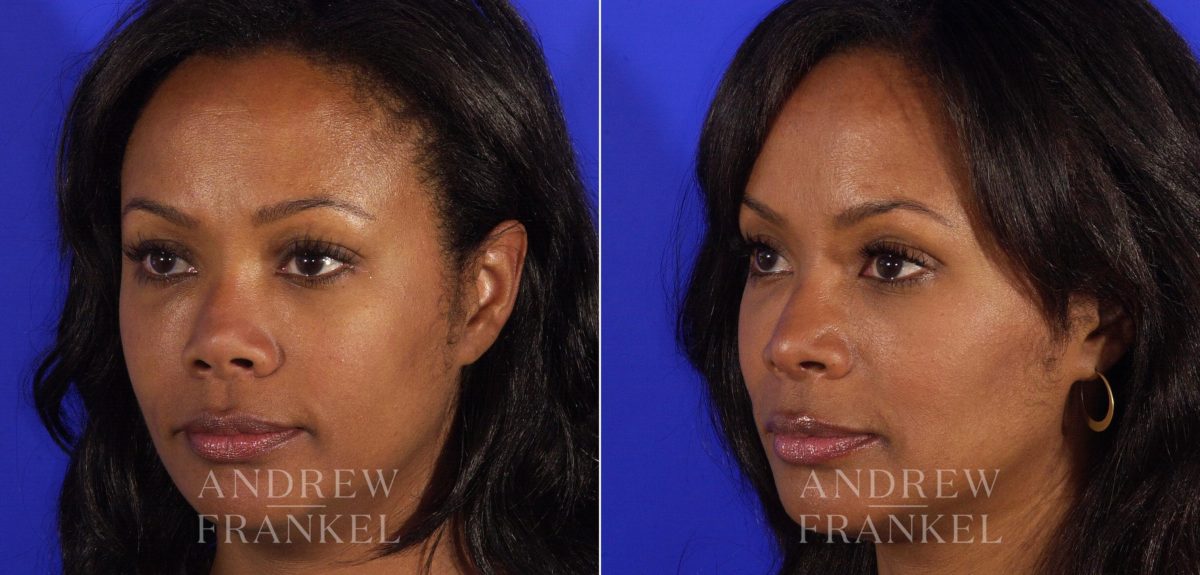 Revision Rhinoplasty before and after photos in Beverly Hills, CA, Patient 4873