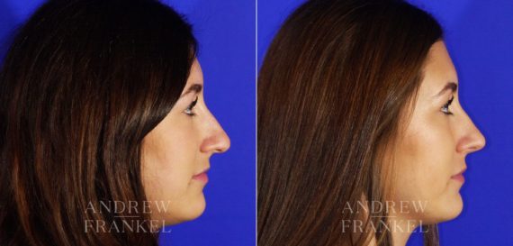 Rhinoplasty before and after photos in Beverly Hills, CA, Patient 4943