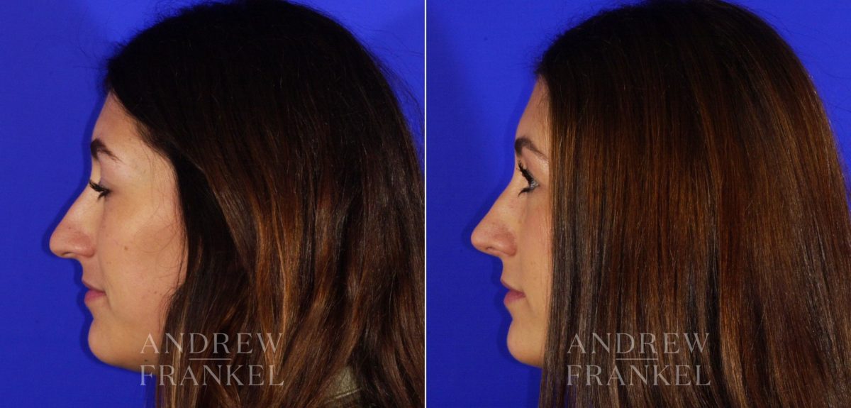 Rhinoplasty before and after photos in Beverly Hills, CA, Patient 4943