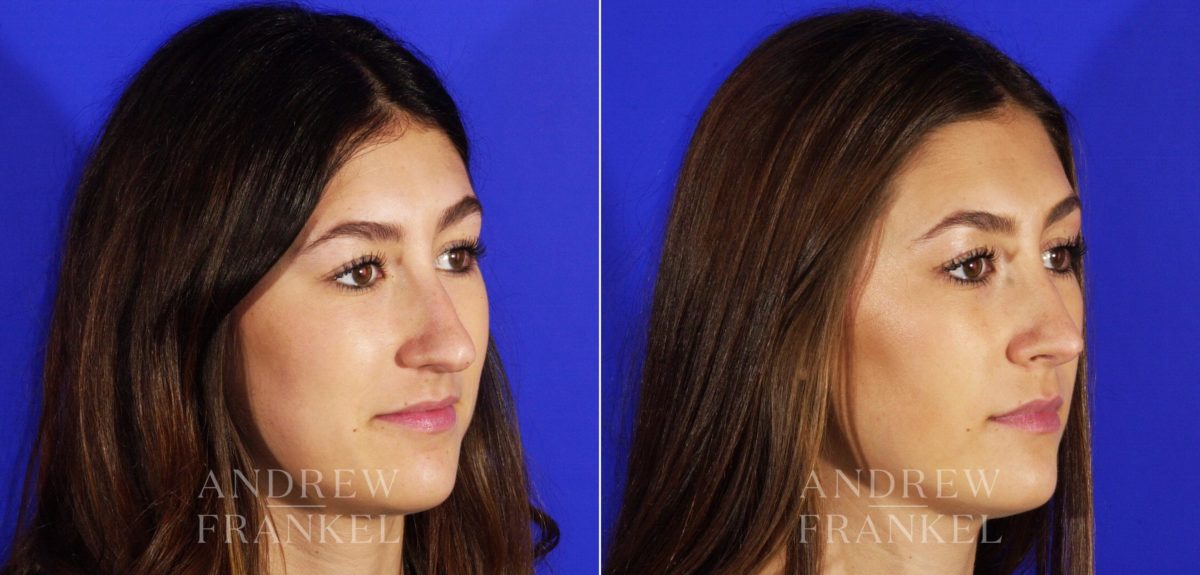 Rhinoplasty before and after photos in Beverly Hills, CA, Patient 4943