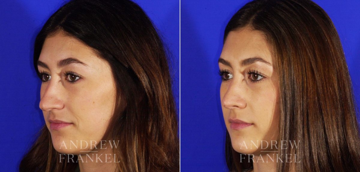 Rhinoplasty before and after photos in Beverly Hills, CA, Patient 4943