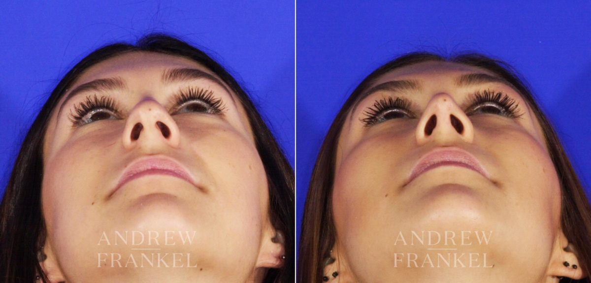 Rhinoplasty before and after photos in Beverly Hills, CA, Patient 4943