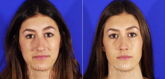 Rhinoplasty before and after photos in Beverly Hills, CA, Patient 4943