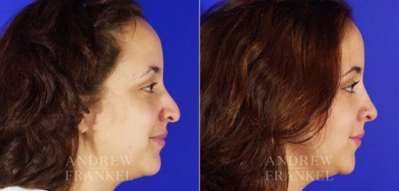 Rhinoplasty before and after photos in Beverly Hills, CA, Patient 4985