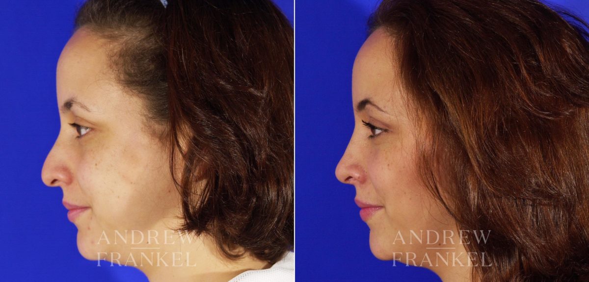 Rhinoplasty before and after photos in Beverly Hills, CA, Patient 4985
