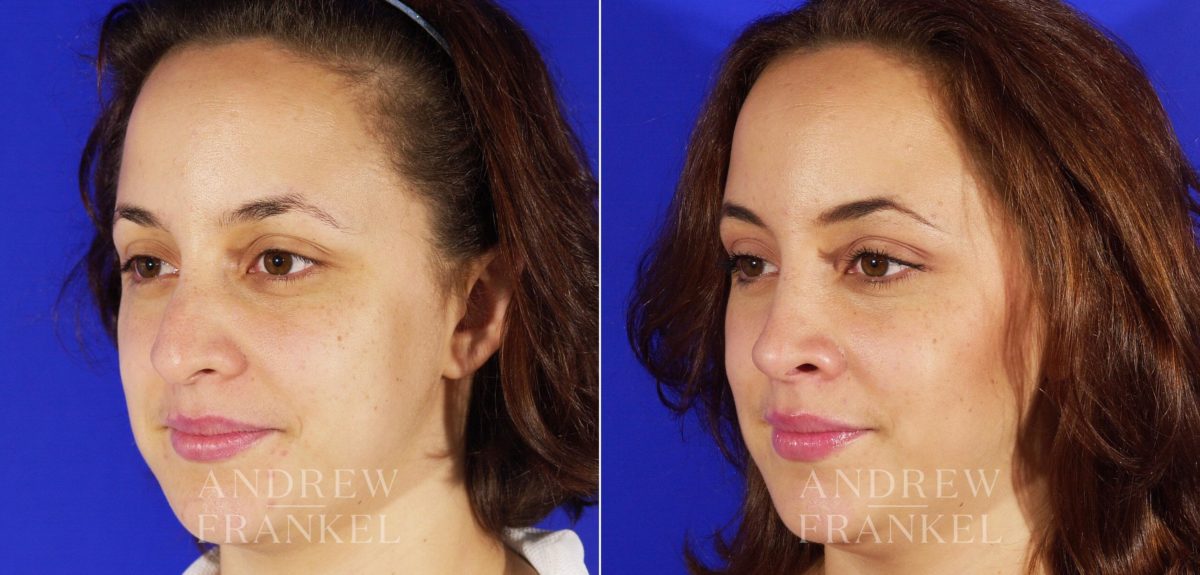 Rhinoplasty before and after photos in Beverly Hills, CA, Patient 4985