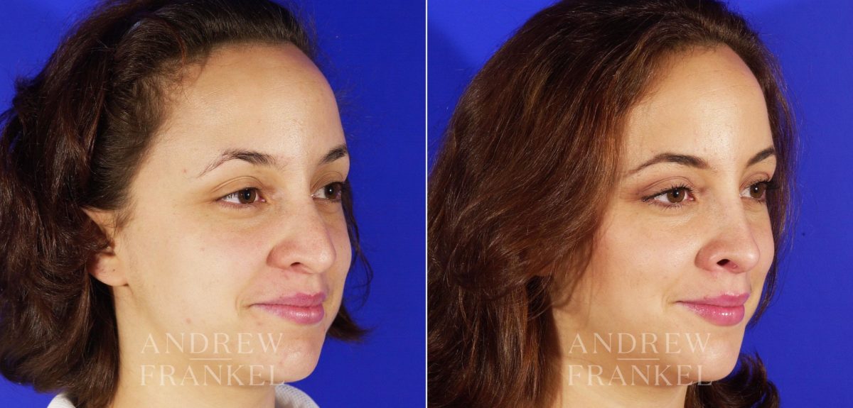 Rhinoplasty before and after photos in Beverly Hills, CA, Patient 4985