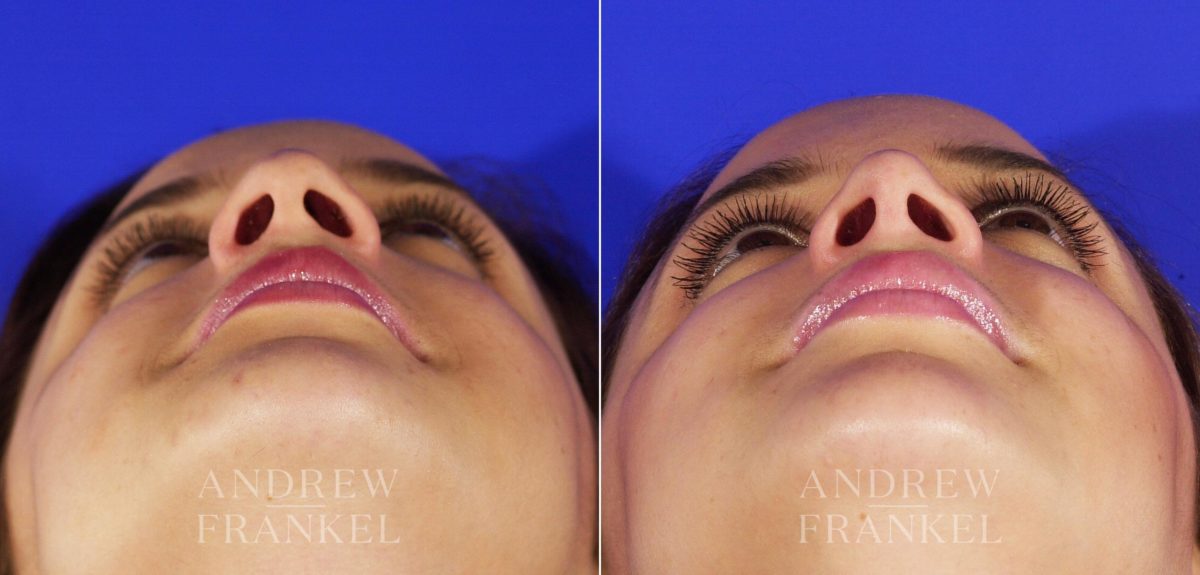 Rhinoplasty before and after photos in Beverly Hills, CA, Patient 4985