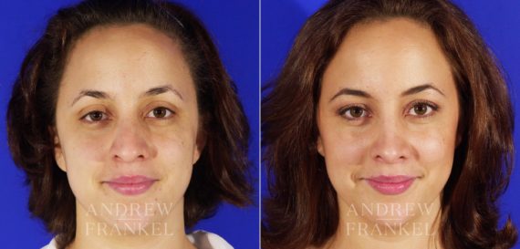 Rhinoplasty before and after photos in Beverly Hills, CA, Patient 4985