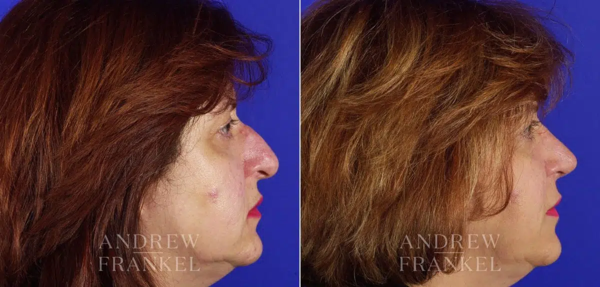 Rhinoplasty before and after photos in Beverly Hills, CA, Patient 5032
