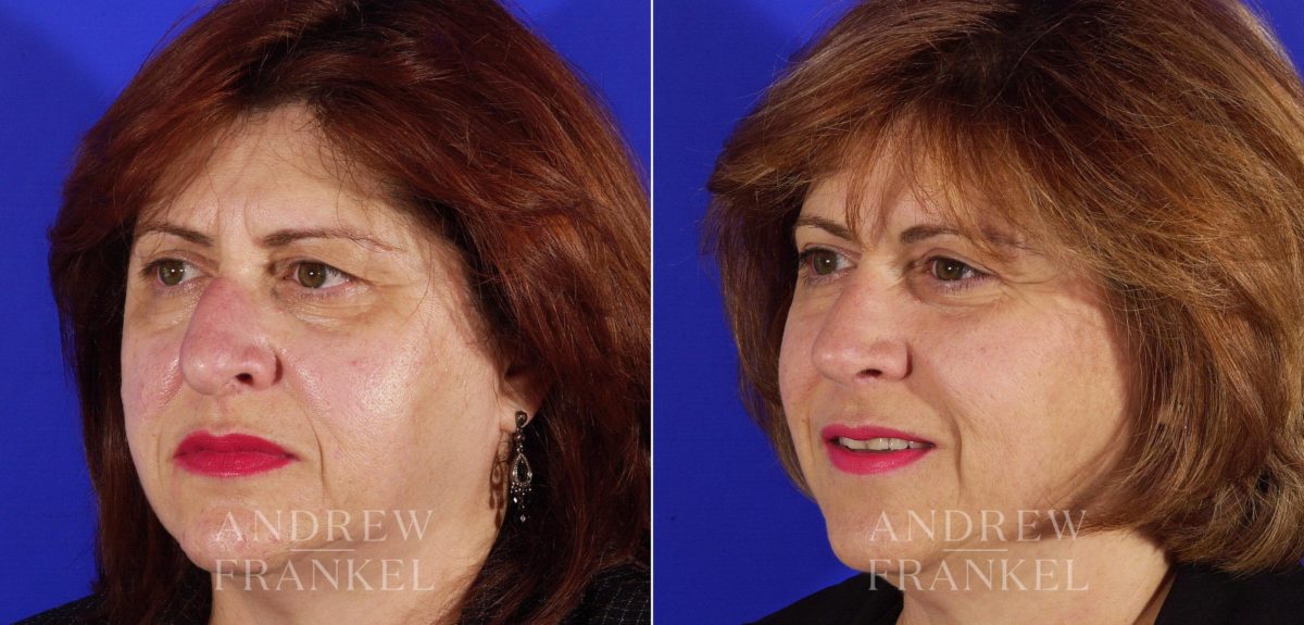 Rhinoplasty before and after photos in Beverly Hills, CA, Patient 5032