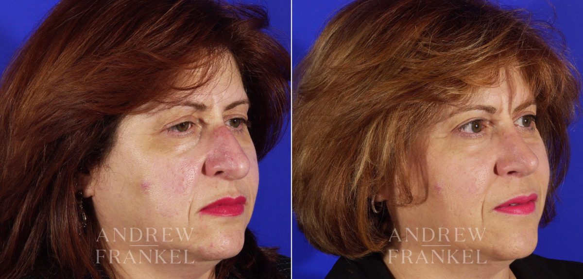 Rhinoplasty before and after photos in Beverly Hills, CA, Patient 5032