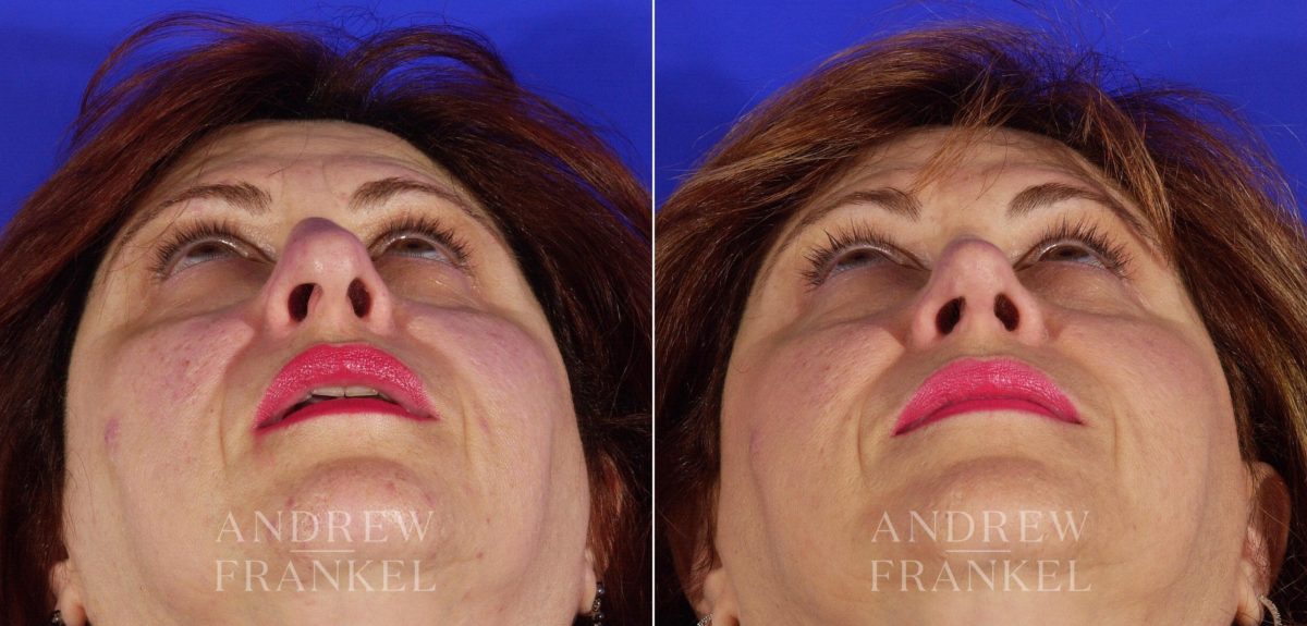 Rhinoplasty before and after photos in Beverly Hills, CA, Patient 5032