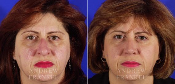 Rhinoplasty before and after photos in Beverly Hills, CA, Patient 5032