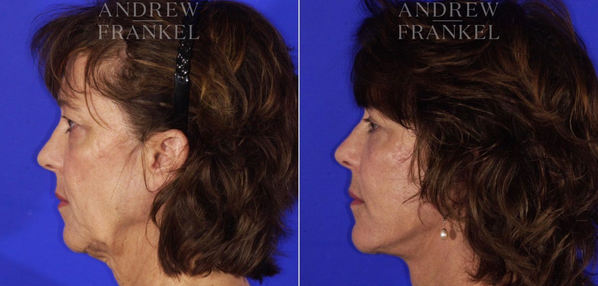Facelift before and after photos in Beverly Hills, CA, Patient 5033