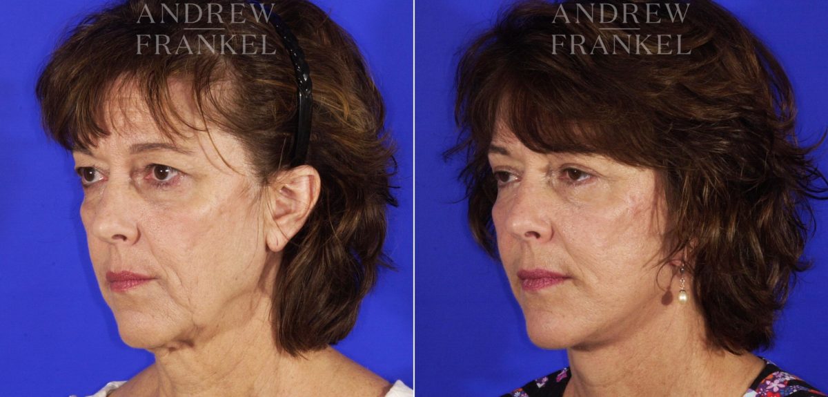 Facelift before and after photos in Beverly Hills, CA, Patient 5033