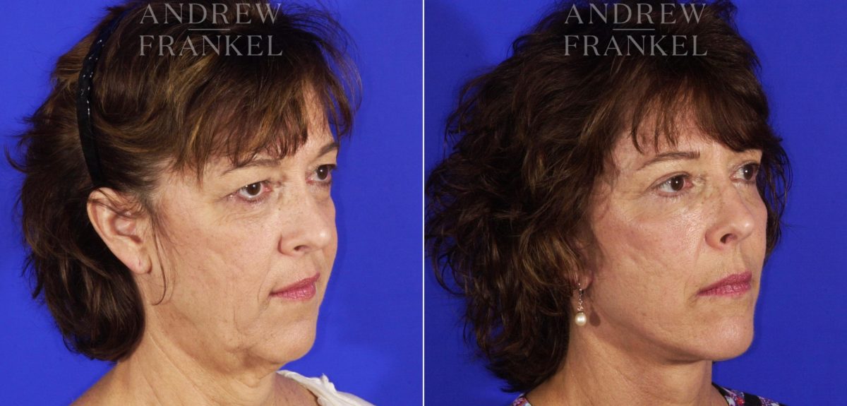 Facelift before and after photos in Beverly Hills, CA, Patient 5033