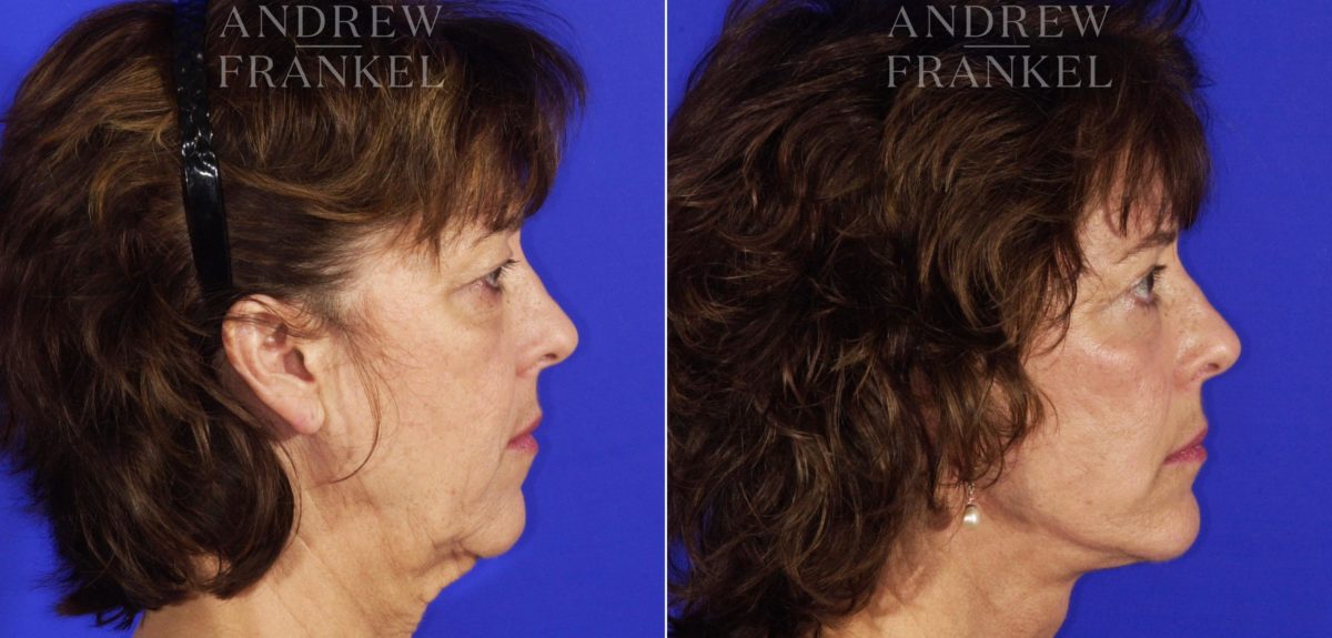 Facelift before and after photos in Beverly Hills, CA, Patient 5033