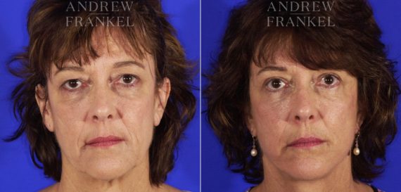 Facelift before and after photos in Beverly Hills, CA, Patient 5033